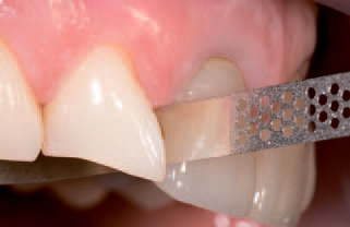 Алмазная перфорированная полоска NTI